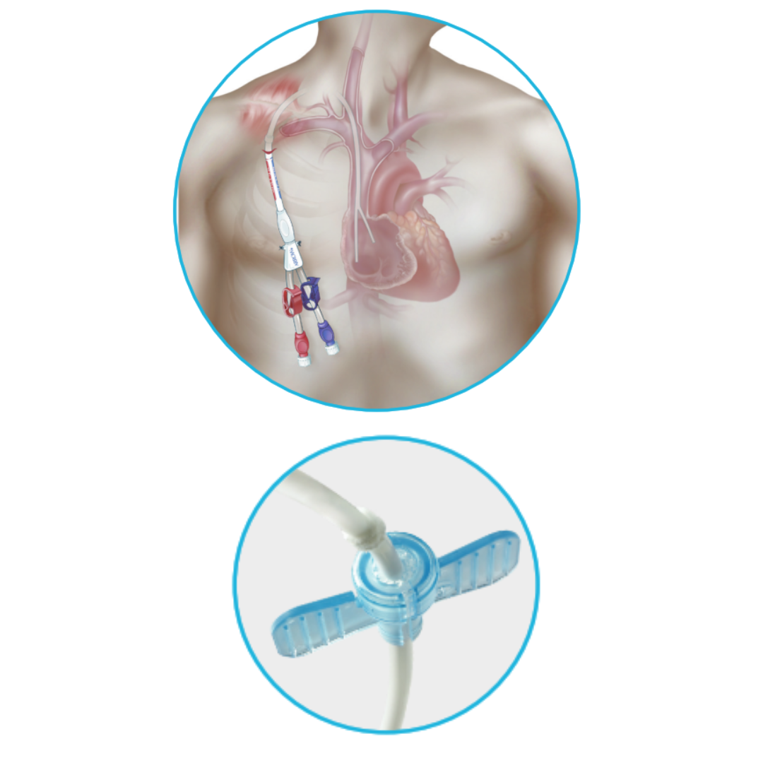 Imagen #0 del producto CATÉTER PERMANENTE PARA HEMODIÁLISIS 2 LUMEN 15 FR X 28 CM - ARROW